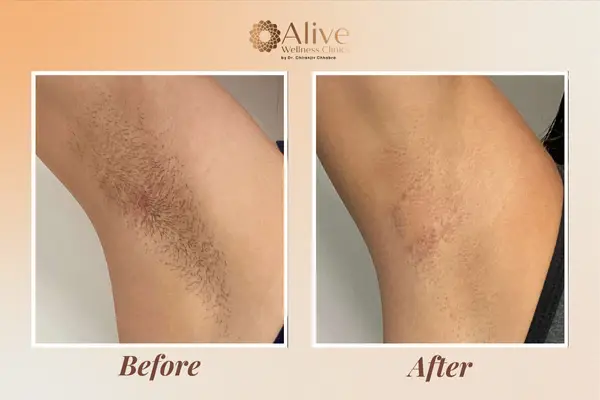 Laser hair removal before and after