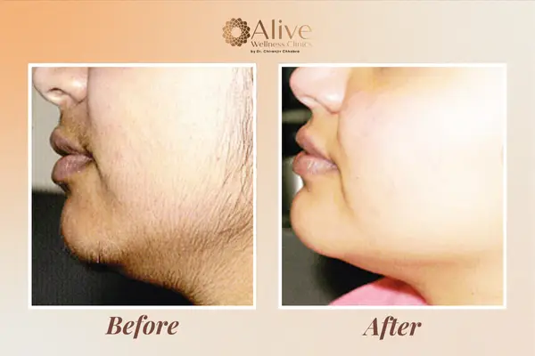 LHR Before and After